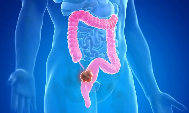 5 loại ung thư phổ biến nhất tại Việt Nam