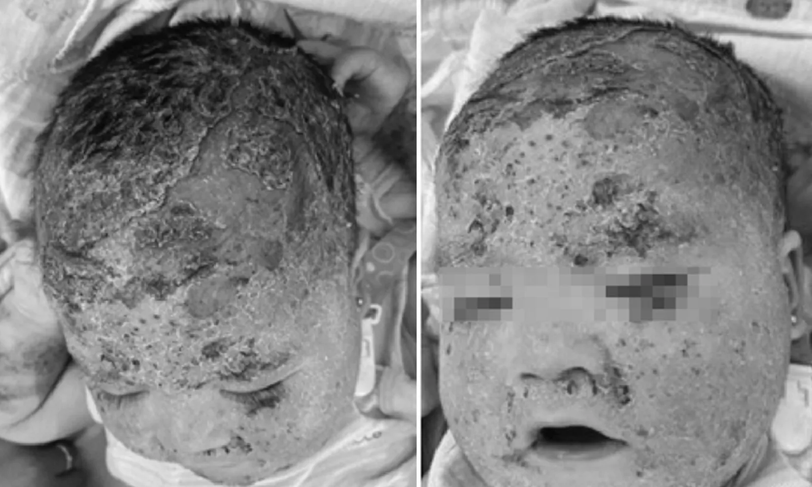 Bé trai bị viêm da nặng do được tắm nhiều loại lá