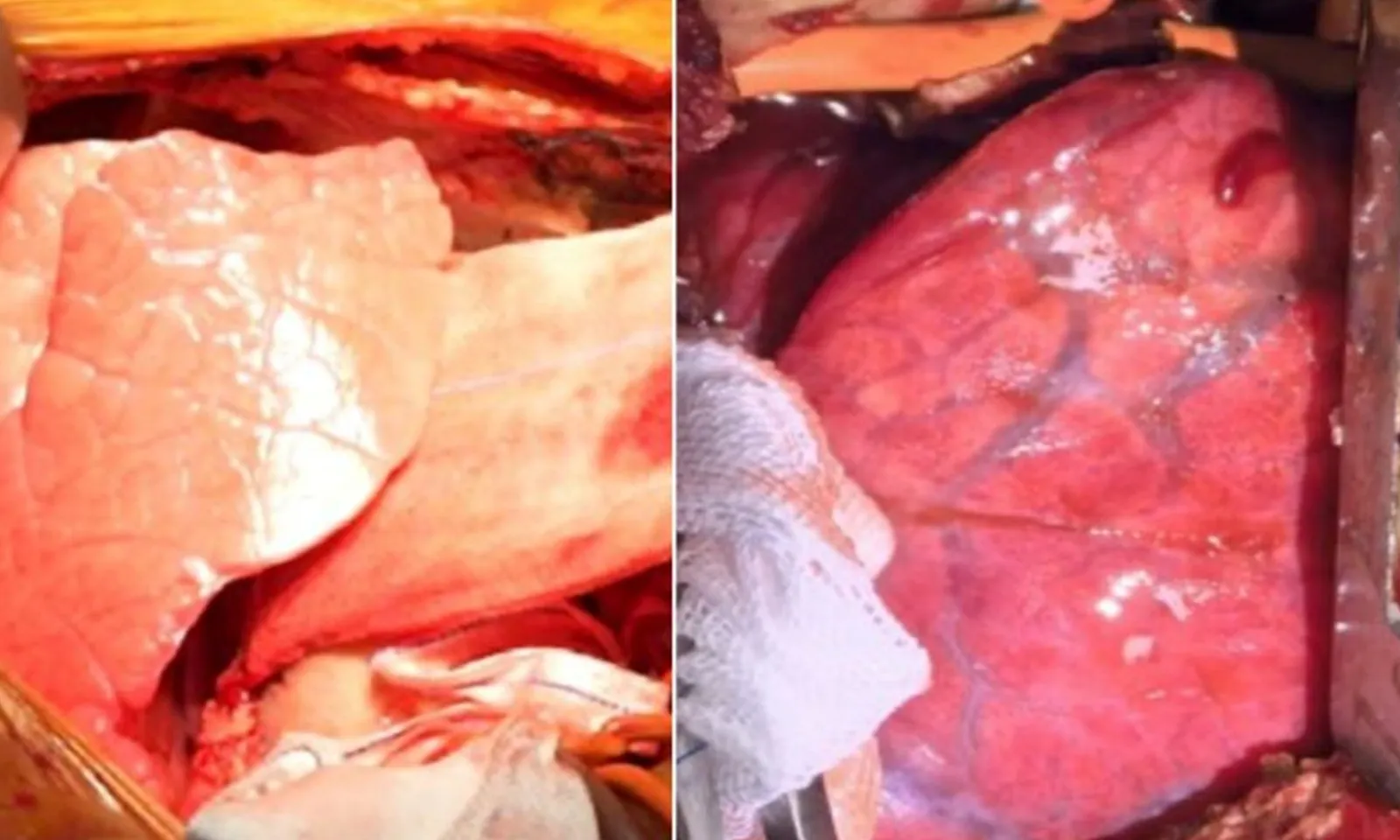 Lần đầu tiên, phổi heo biến đổi gen được cấy ghép cho một người chết não