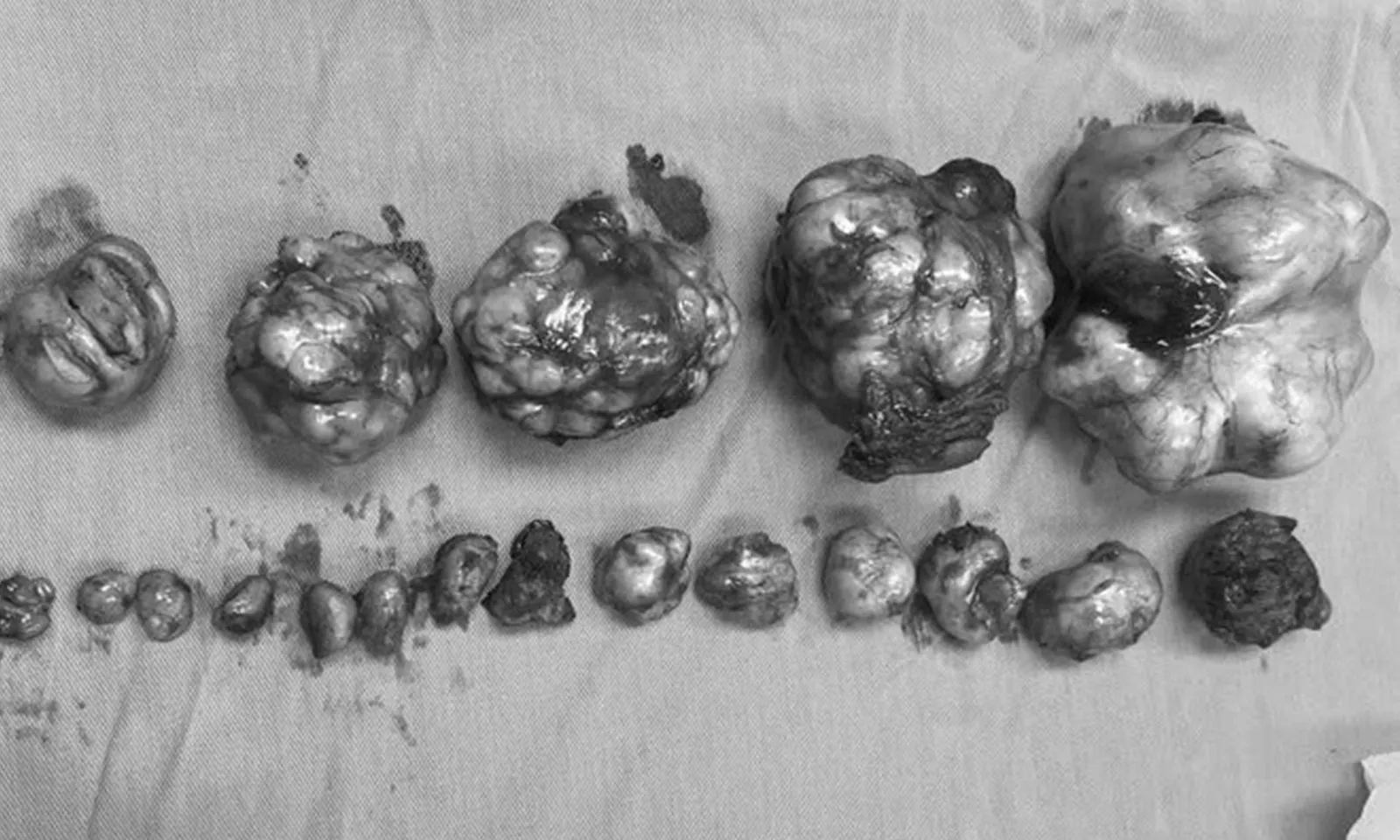 Phát hiện 19 khối u xơ trong tử cung người phụ nữ 32 tuổi