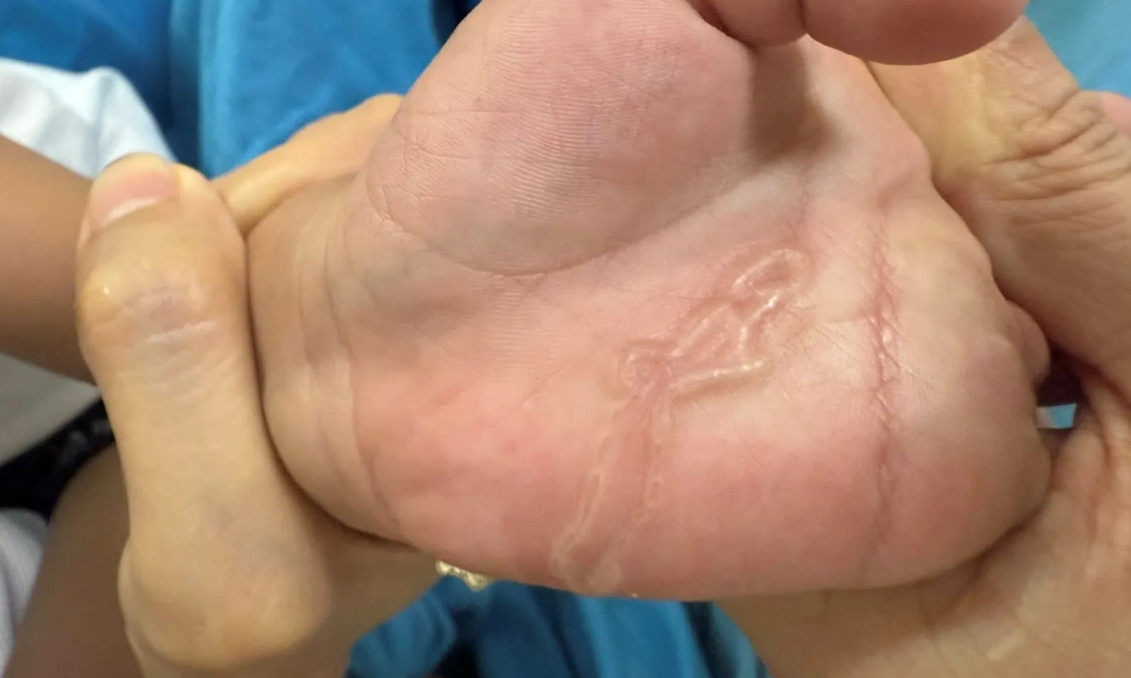 Bé trai 4 tuổi nhiễm sán máng từ vết xước nhỏ ở kẽ ngón tay