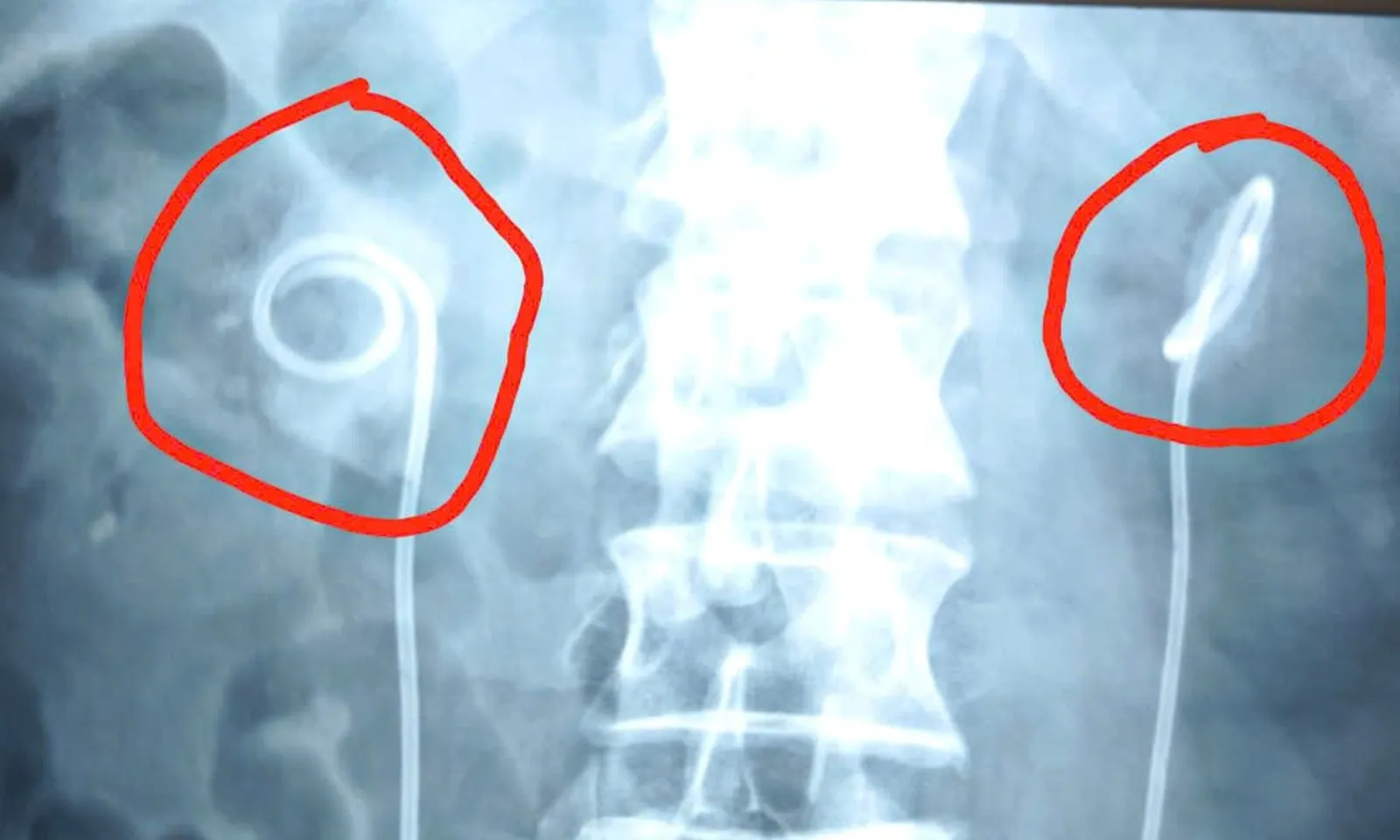 “Quên” rút ‘ống thông tiểu’ trong suốt 2 năm, người đàn ông gặp biến chứng nguy hiểm