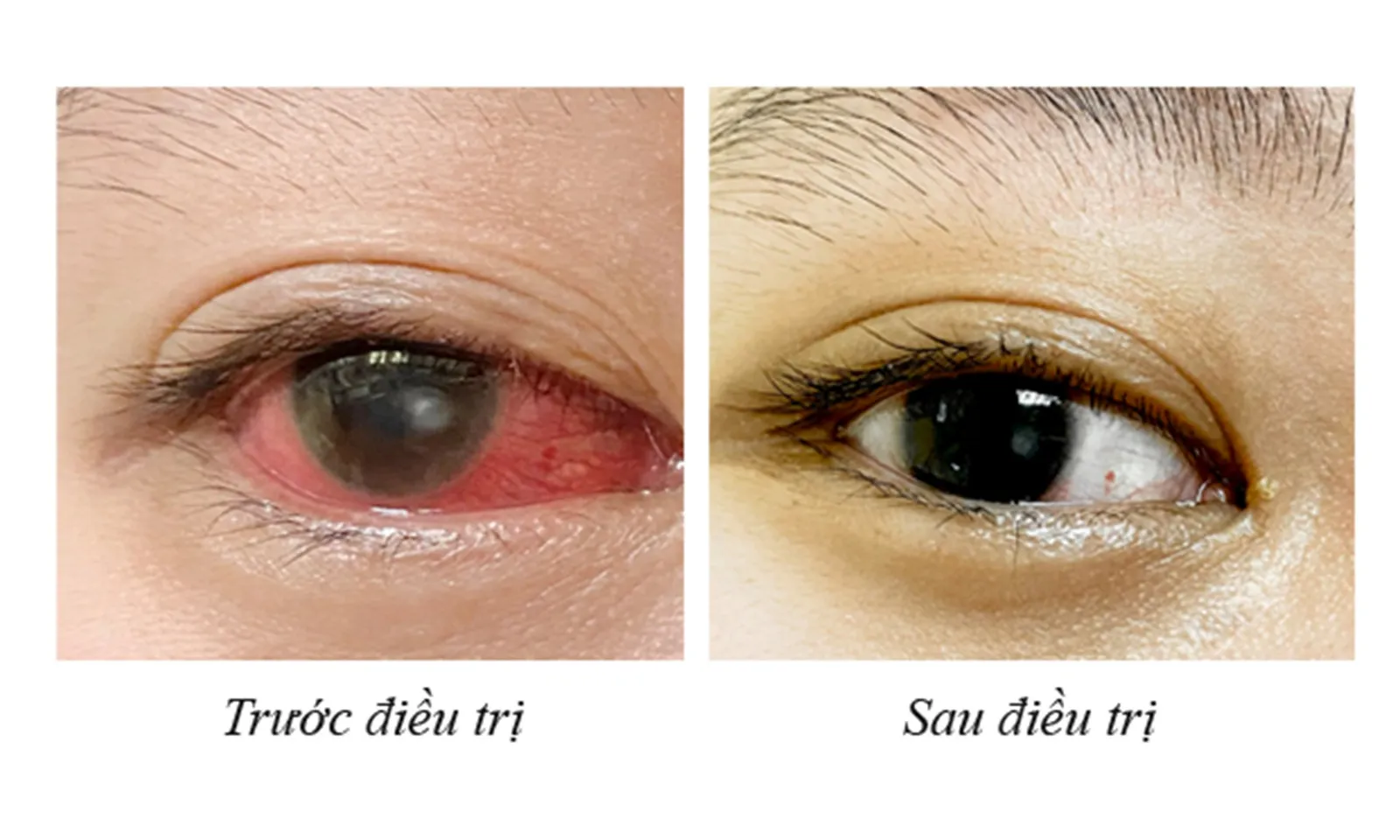 Cô gái bị loét giác mạc vì thường xuyên đeo kính áp tròng