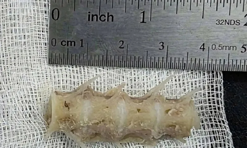 Quảng Trị: Cứu sống cụ ông 99 tuổi hóc xương cá