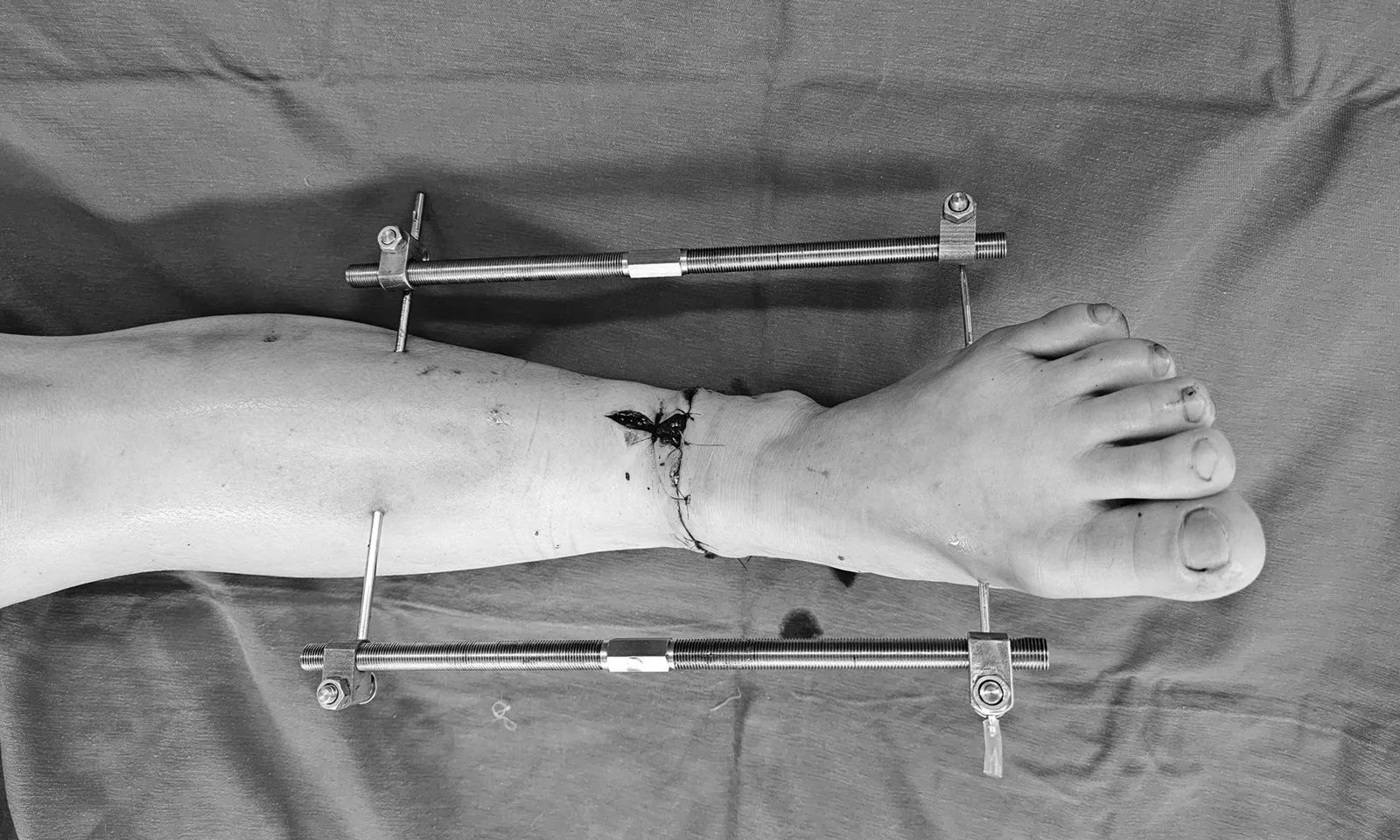 Cứu người phụ nữ bị máy cắt cỏ chém đứt rời cẳng chân