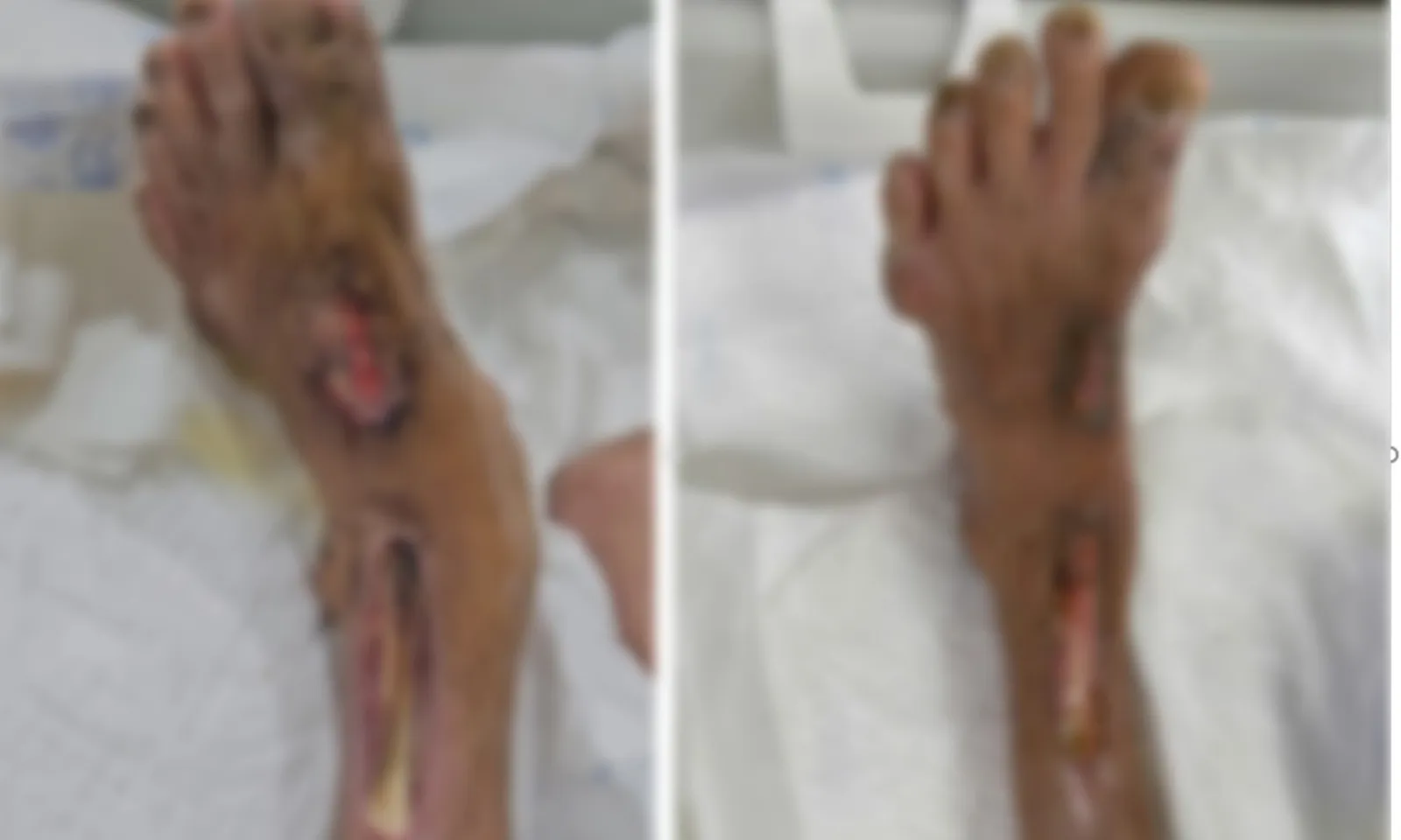 Người đàn ông nguy kịch vì tự nặn mủ ở ngón chân