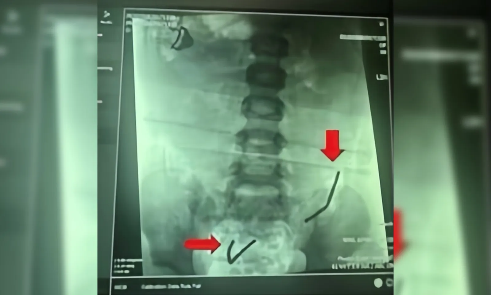 Bé trai thủng nhiều lỗ ở ruột do nuốt hơn 30 viên nam châm