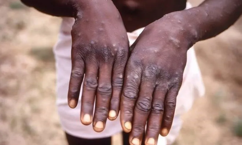 WHO dỡ bỏ tình trạng khẩn cấp toàn cầu đối với bệnh đậu mùa khỉ