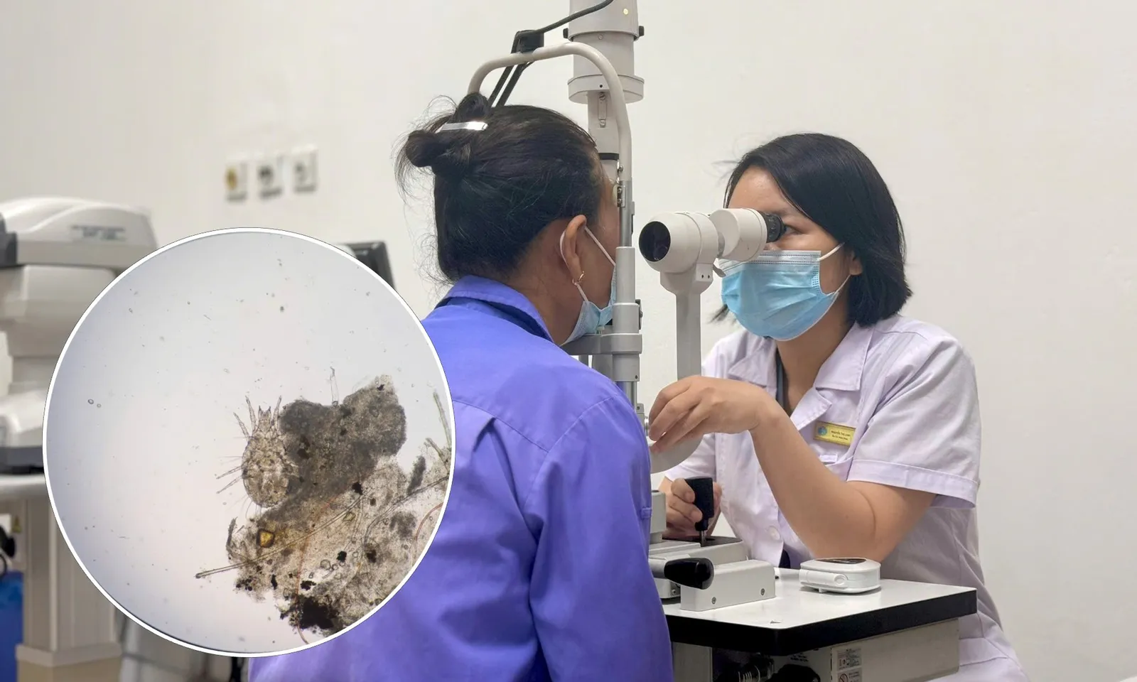 Ngứa mi mắt suốt 3 năm, cụ bà bất ngờ phát hiện… rận ký sinh trên mi mắt