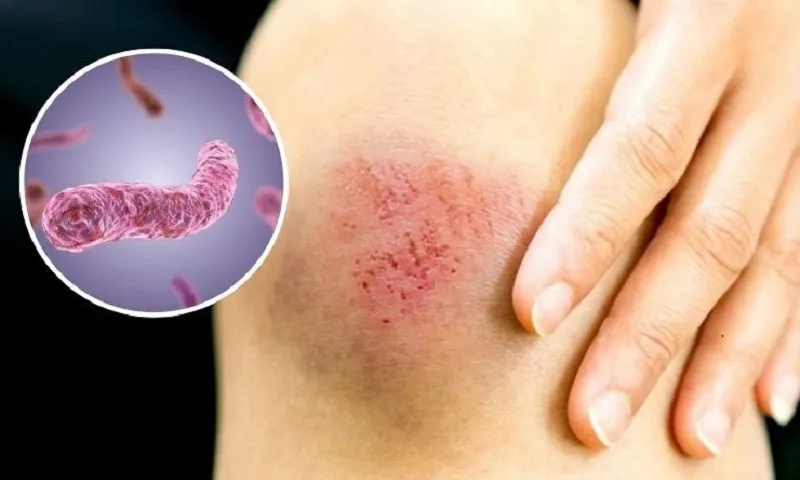 Đắk Lắk ghi nhận ca tử vong đầu tiên do bệnh Whitmore