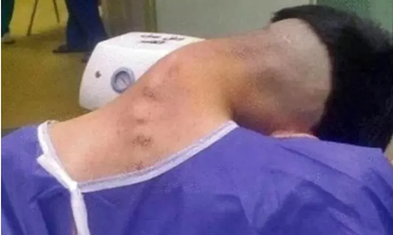 Hội chứng “đầu rơi” do sử dụng ma túy