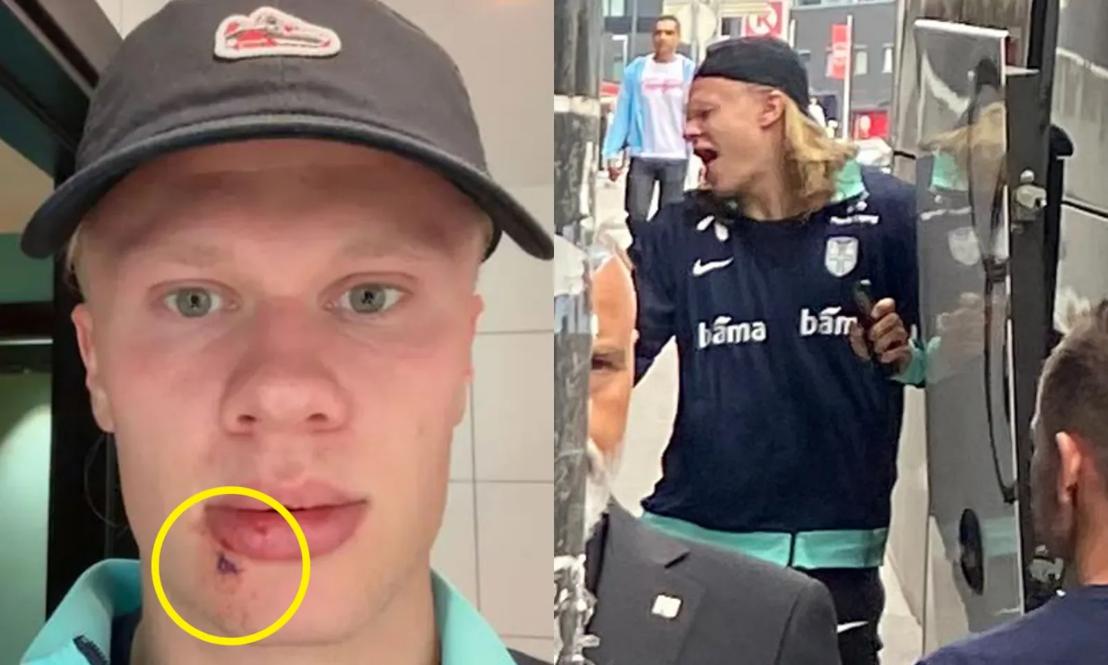 Phải khâu 3 mũi, Haaland tuyên bố trút giận lên MU