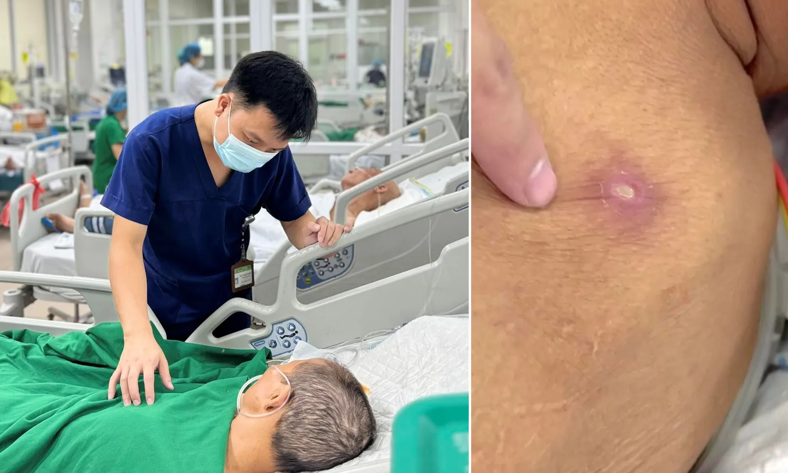 Hai bệnh nhân nguy kịch vì vết đốt của ấu trùng mò