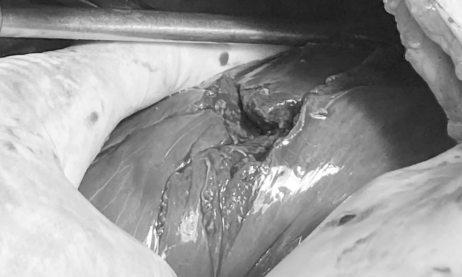 Cứu sống thiếu niên bị vỡ gan do tai nạn giao thông