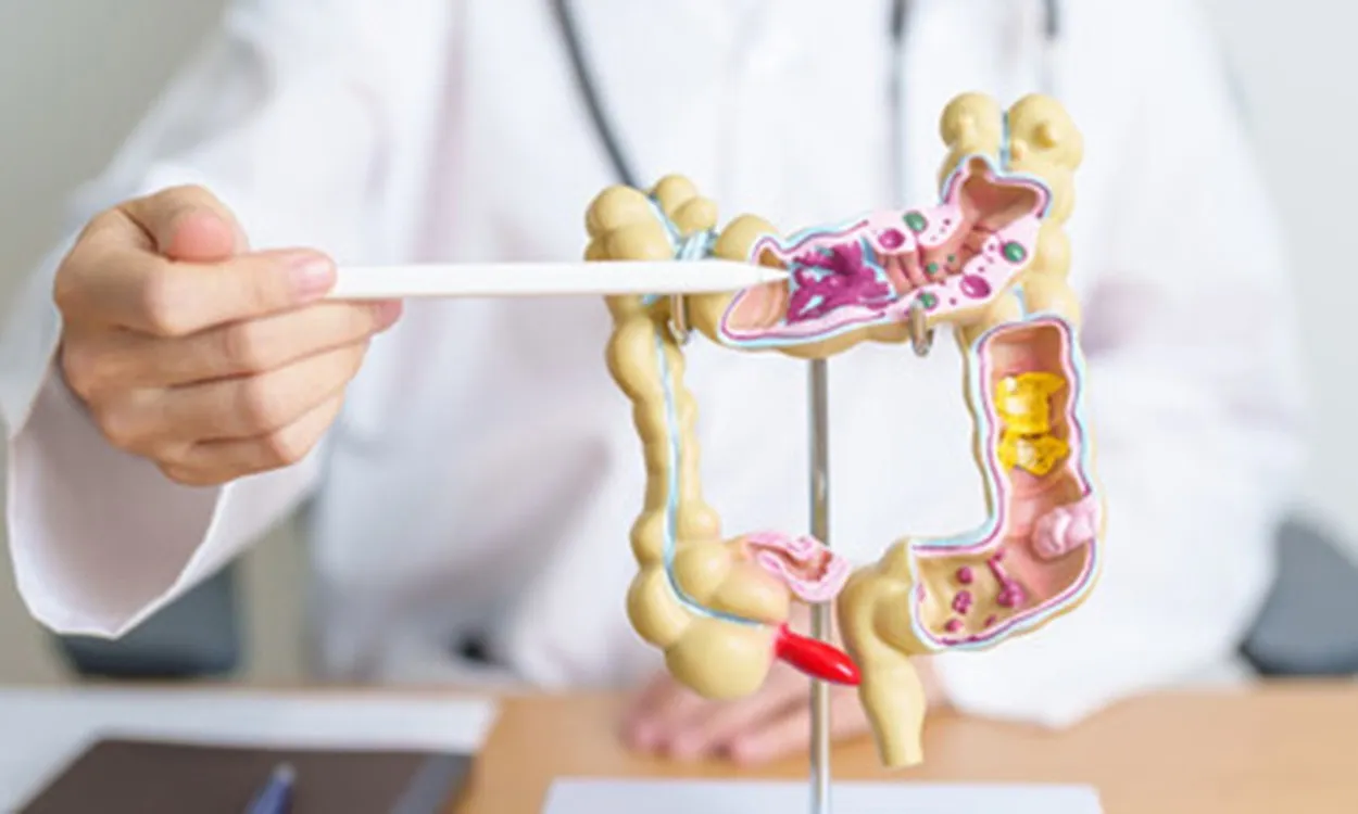 Nghiên cứu mới: Aspirin liều thấp có thể giảm hơn 50% nguy cơ tái phát ung thư đại trực tràng