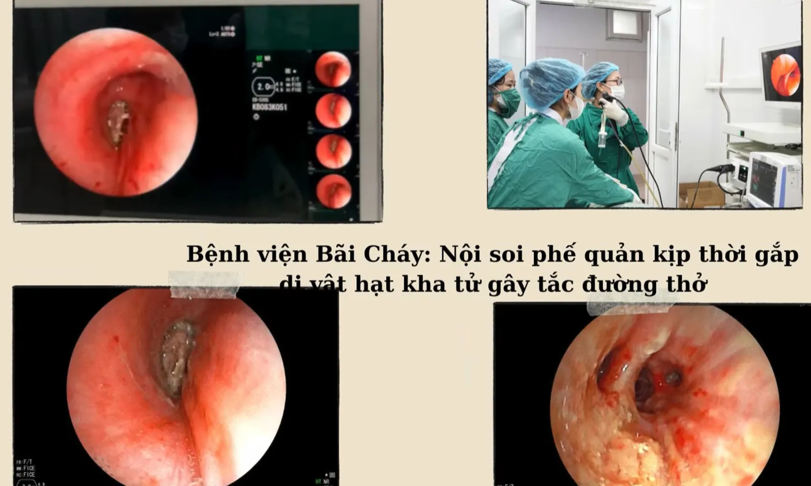 Gắp hạt kha tử nằm sâu trong phế quản, gây tắc nghẽn đường thở