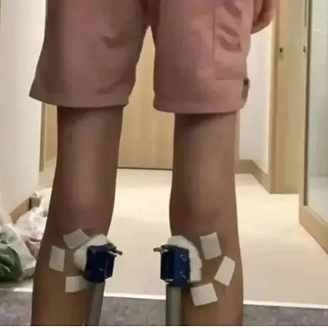 Cậu bé trở lại chiều cao như cũ sau khi ngừng điều trị 2 tuần
