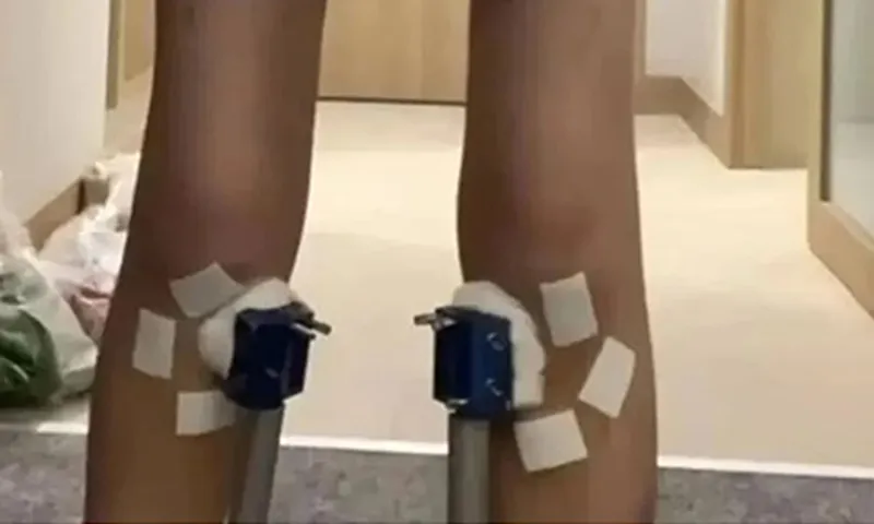 Sau 2 tuần điều trị tăng trưởng, cậu bé lùn đi 1,4cm trở về chiều cao như cũ