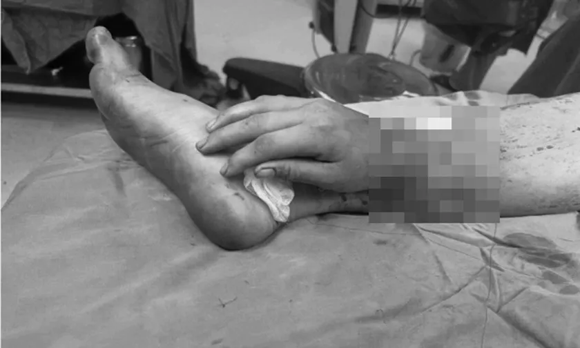 Sản phụ ghép tay vào cẳng chân hồi phục tốt sau 12 ngày phẫu thuật