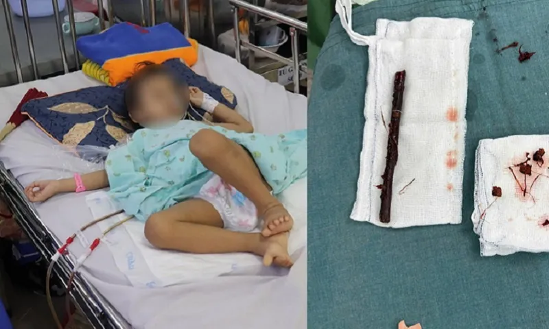 Phẫu thuật lấy nhành cây dài 16cm trong bụng bé gái 3 tuổi