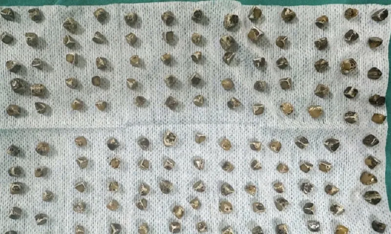 Hy hữu: 130 viên sỏi được lấy ra từ túi mật nữ bệnh nhân ở Phú Thọ