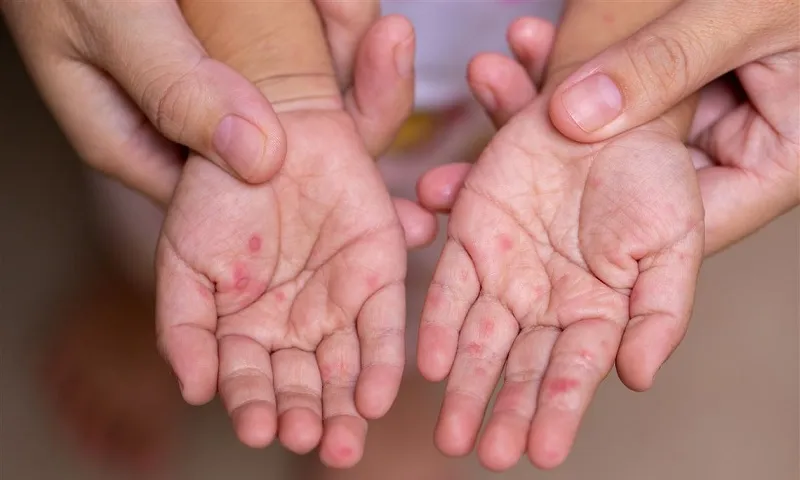 CDC Hà Nội: hơn 4.500 ca tay chân miệng từ đầu năm, hai ổ dịch mới trong tuần