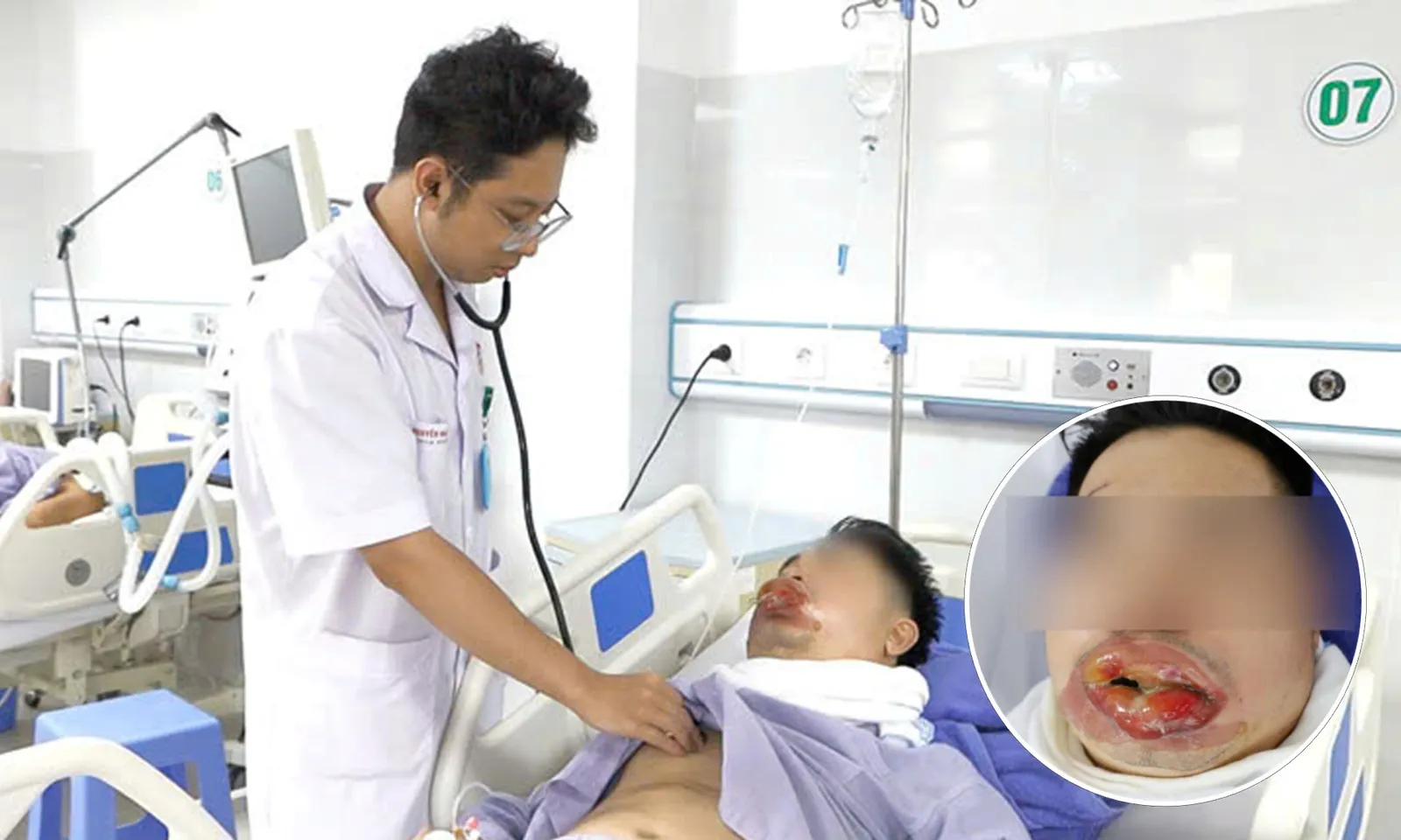 Bị bỏng nặng vùng miệng do xịt khí lạnh chữa bỏng