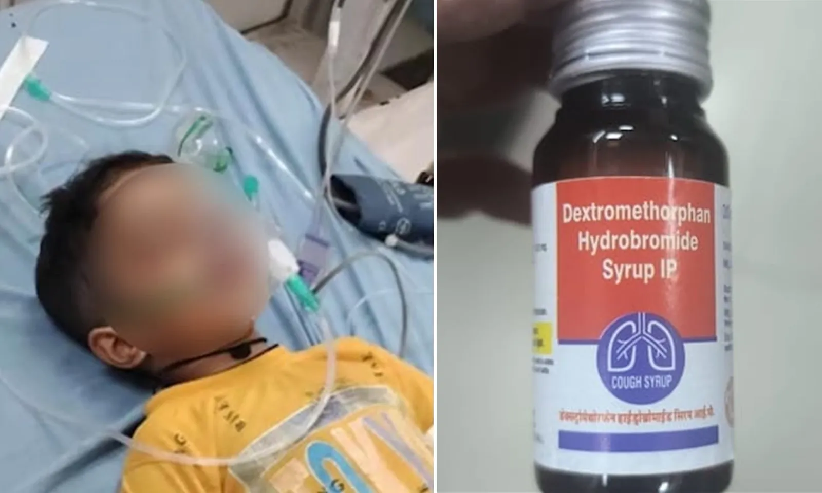 Ấn Độ: 9 trẻ em tử vong do suy thận liên quan đến siro ho