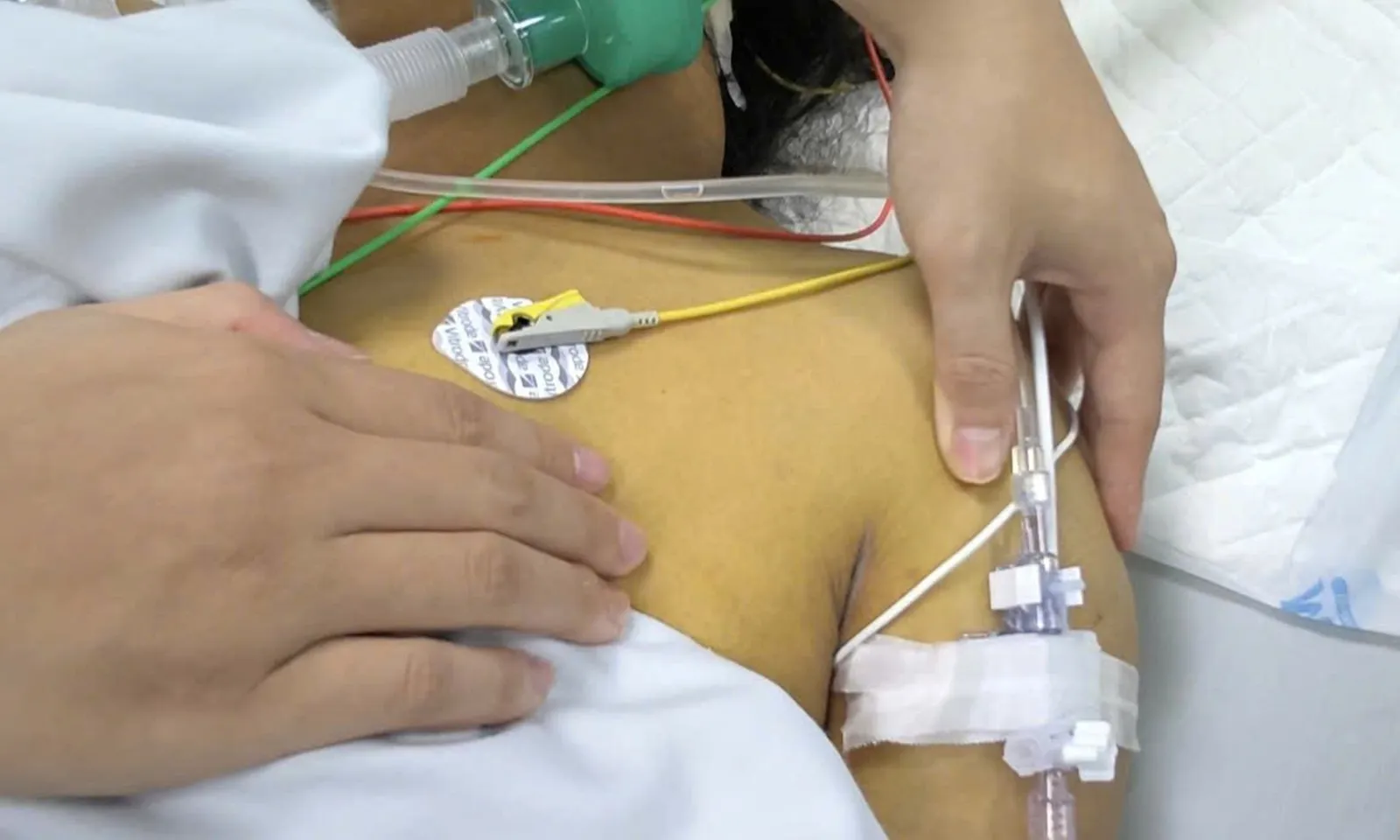 Nữ công nhân nguy kịch nghi do nhiễm xoắn khuẩn vàng da