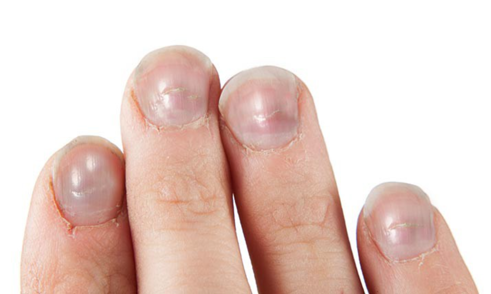 Những dấu hiệu bệnh trên móng tay báo hiệu sức khỏe của bạn