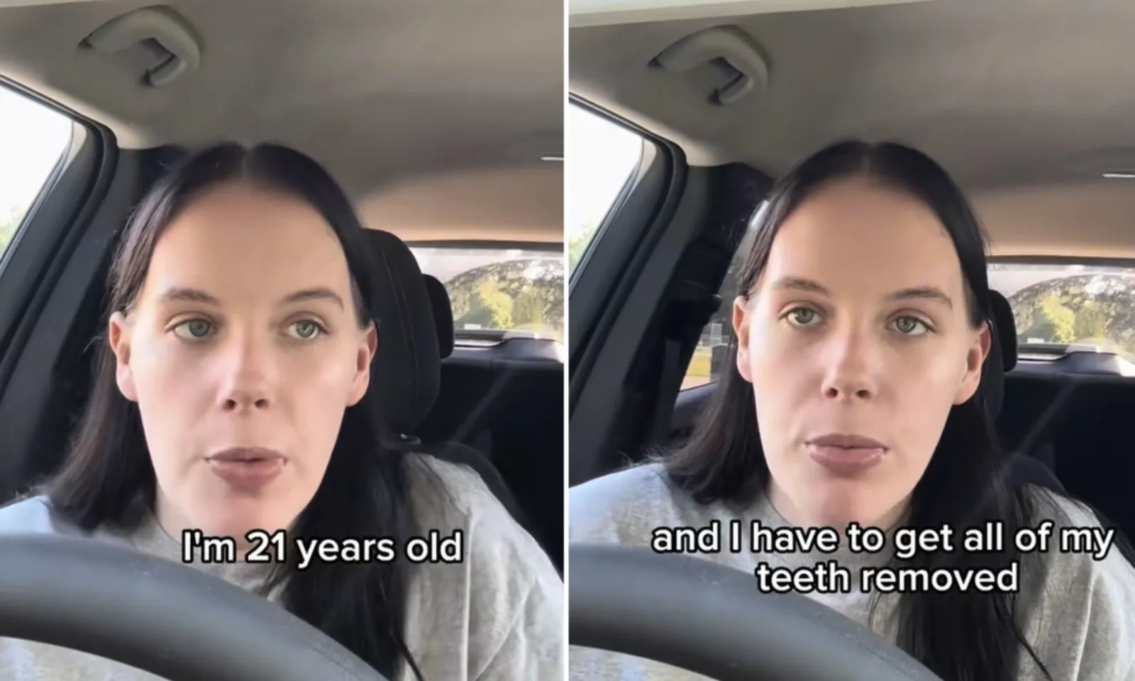 Mất toàn bộ răng ở tuổi 21 vì nhai kẹo cao su và uống nước ngọt