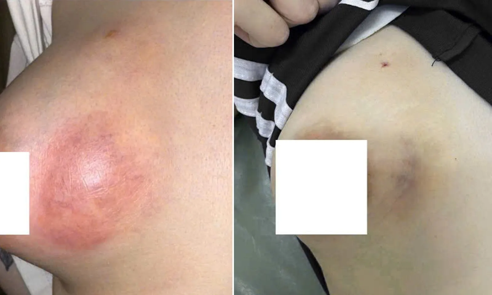 Áp xe vú nặng do tiêm chất làm đầy không rõ nguồn gốc