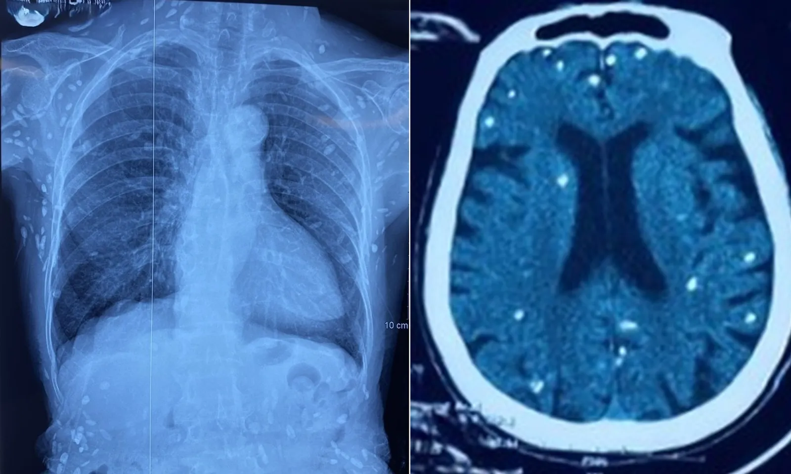 Cụ bà bị nhiễm ấu trùng sán dây heo, nang sán lan khắp cơ thể
