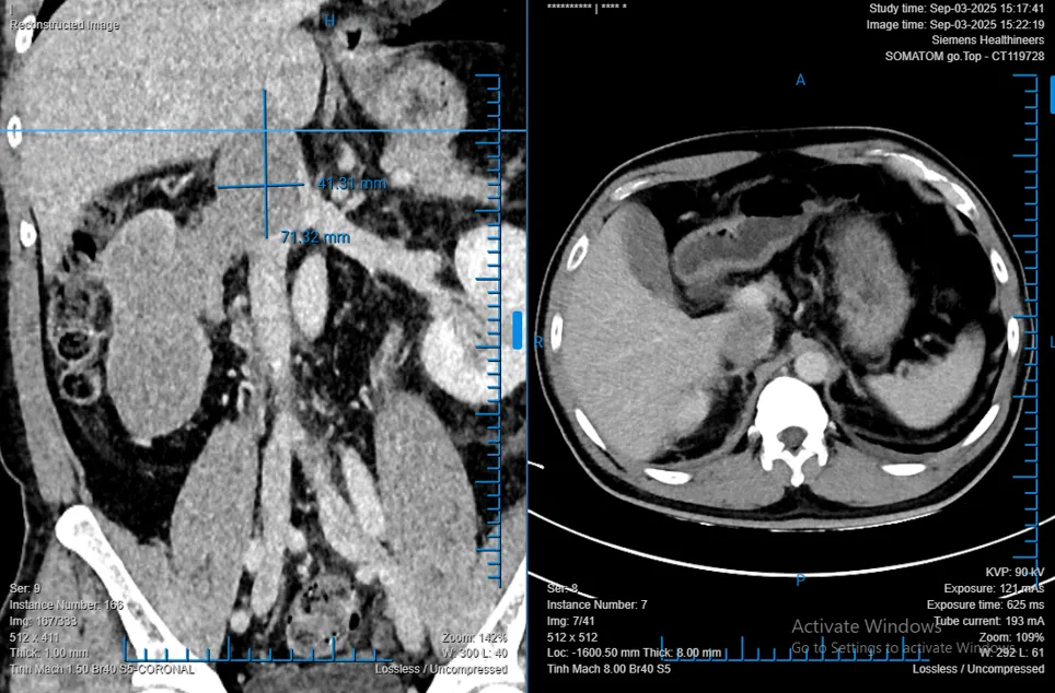 03 Hình ảnh khối ung thư biểu mô tế bào thận có huyết khối bướu trên phim CT-scan của người bệnh T.D.L.