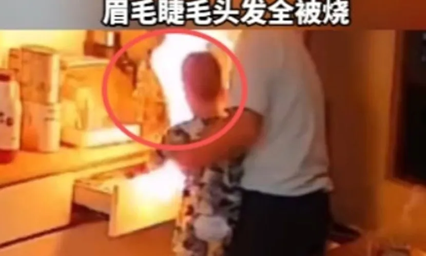 Cháu bé bị bỏng do ông nội dùng bật lửa “chơi đùa” cùng