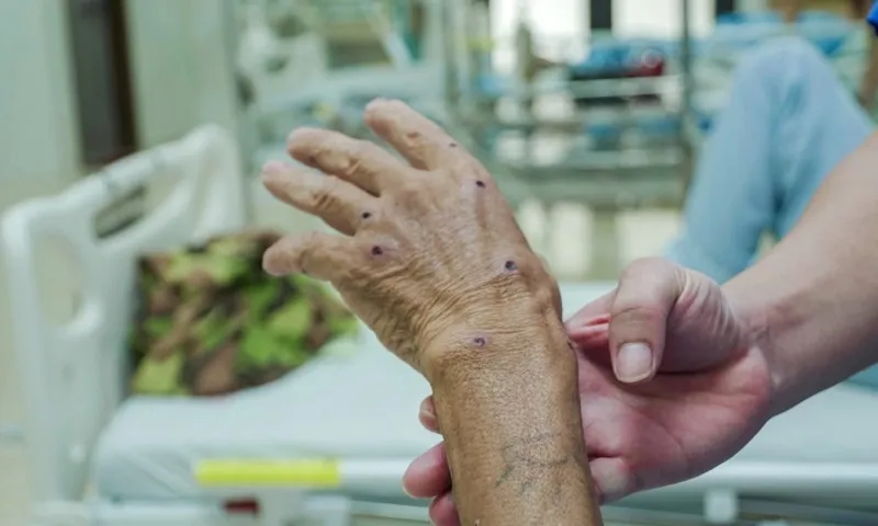 Phú Thọ: Người đàn ông bị ong vò vẽ đốt 117 nốt, sốc phản vệ mức độ nặng