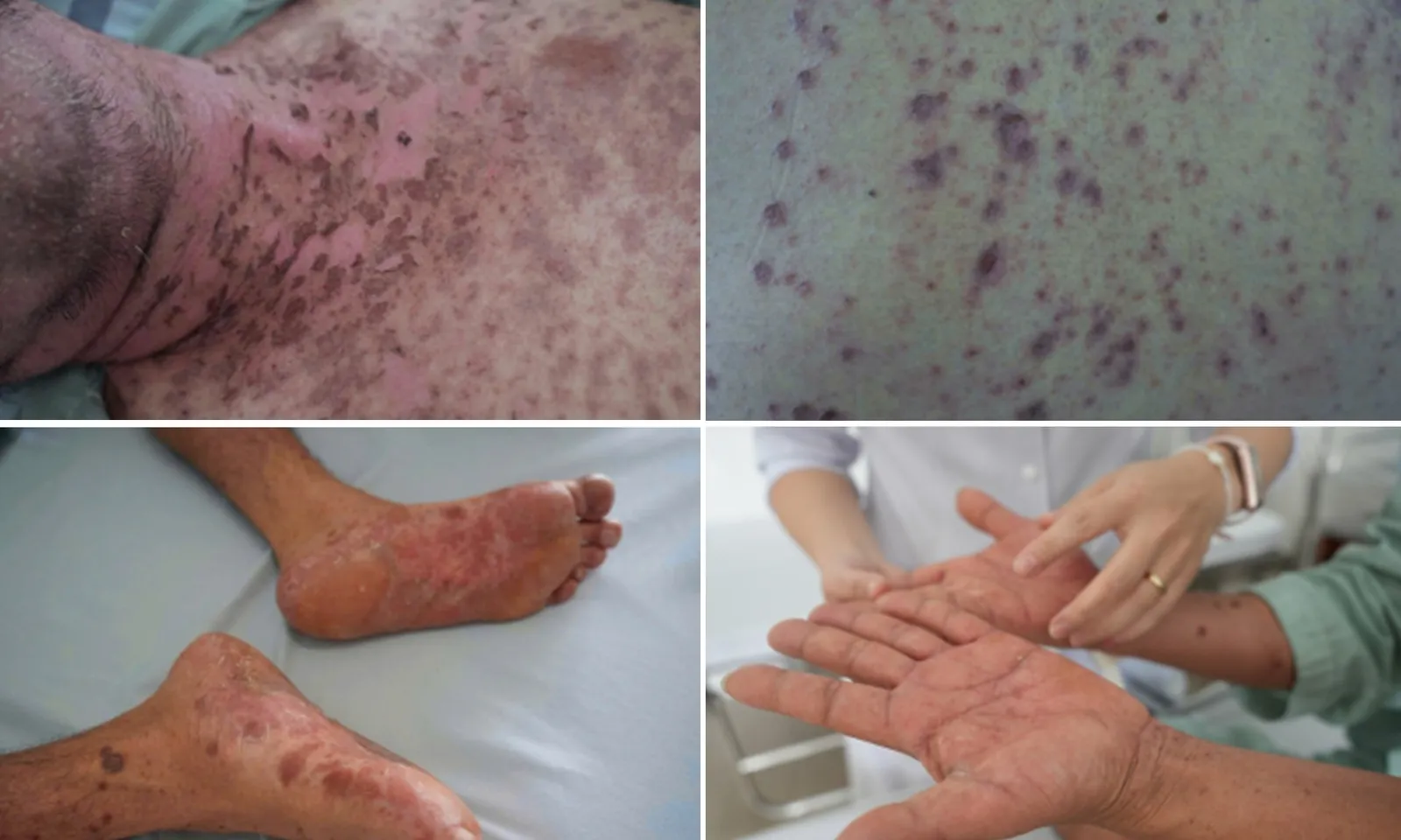 Dị ứng nặng do dùng thuốc giảm đau không rõ nguồn gốc