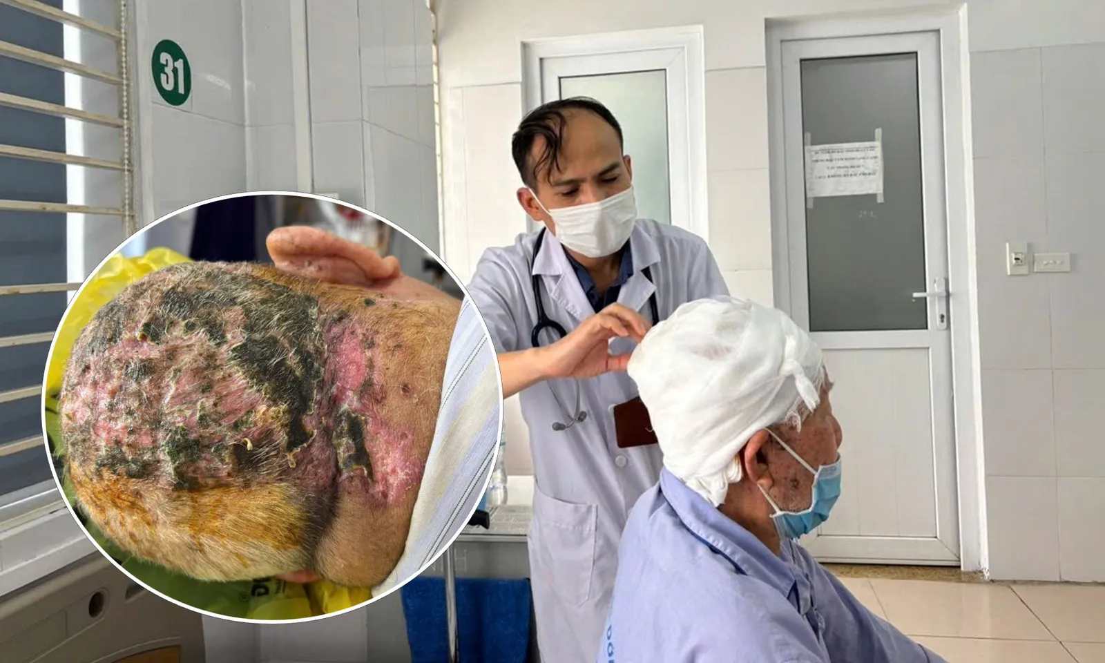 “Đắp lá” chữa zona, cụ ông loét rộng vùng đầu