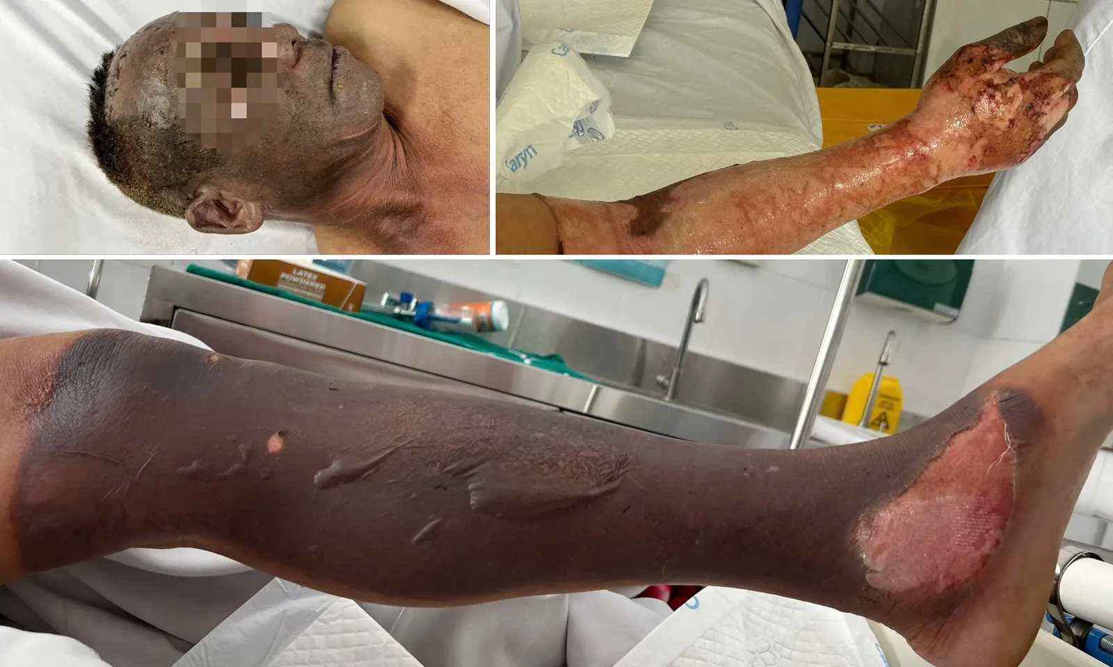 Không chạm vào điện vẫn bị bỏng nặng do tia hồ quang