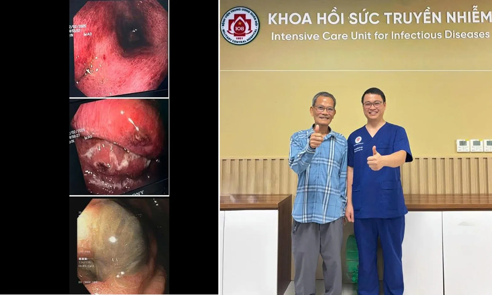 Cứu sống người đàn ông bị hoại tử diện rộng thực quản và dạ dày