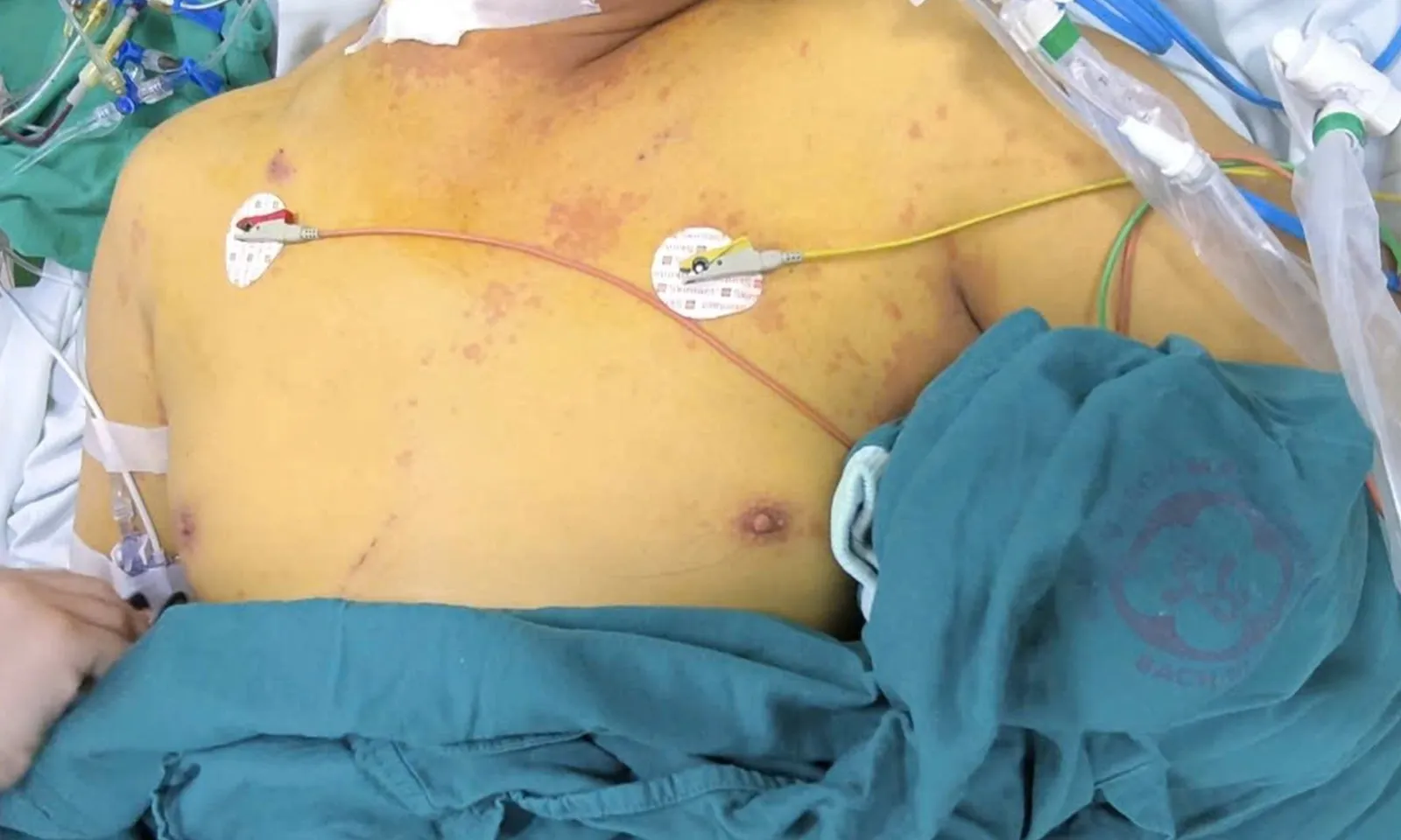 Nhiều người nhiễm xoắn khuẩn vàng da sau mưa lũ dẫn tới suy gan, suy thận nặng