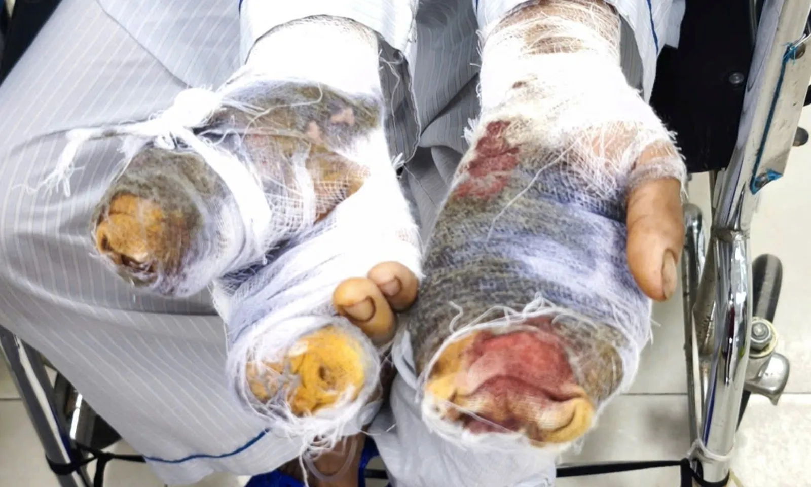 Chó Becgie nặng 30 kg cắn chủ gây thương tích nặng