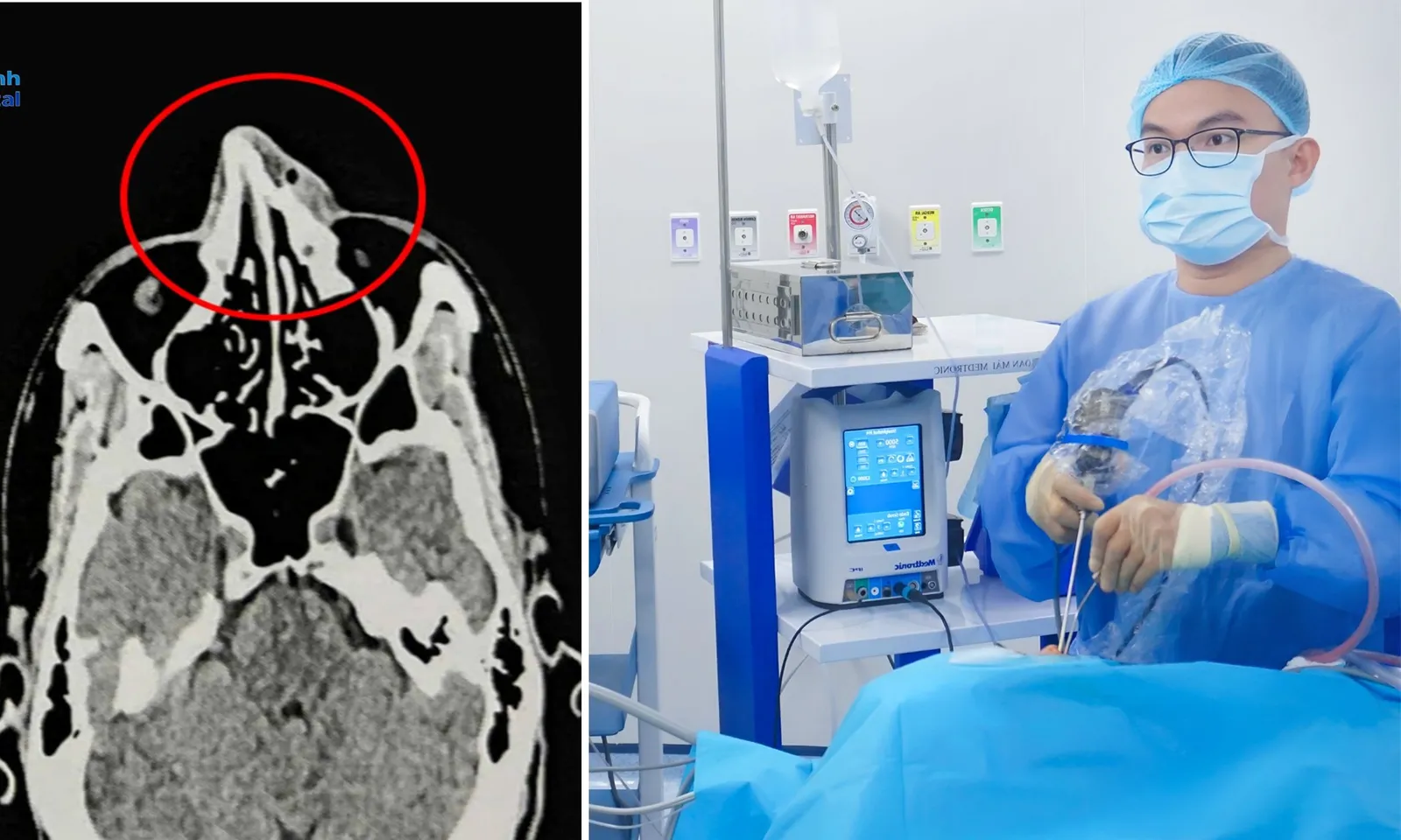 Người đàn ông vỡ xương mũi khi chơi pickleball 