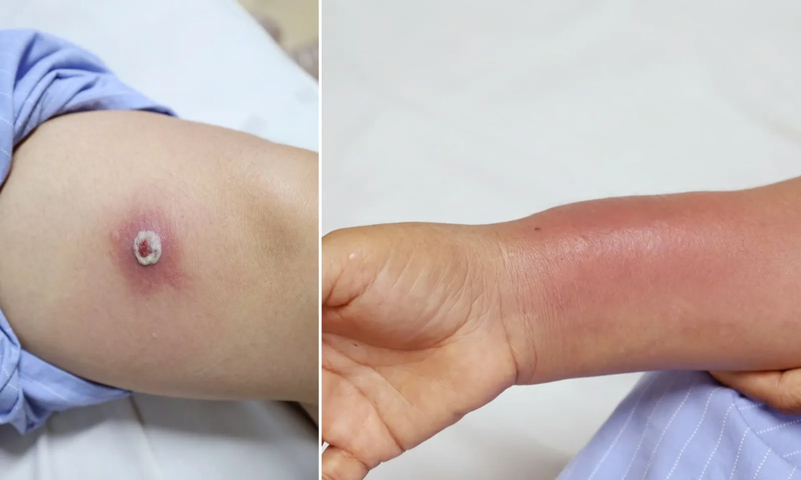 Người phụ nữ bị nhiễm trùng sau khi cấy chỉ “giảm đau xương khớp” tại cơ sở không uy tín