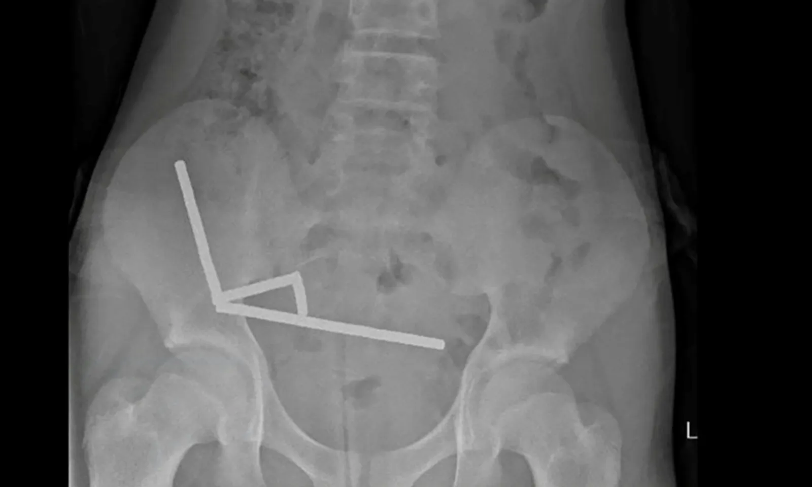 Cậu bé suýt tử vong vì nuốt 100 viên nam châm mua trên mạng