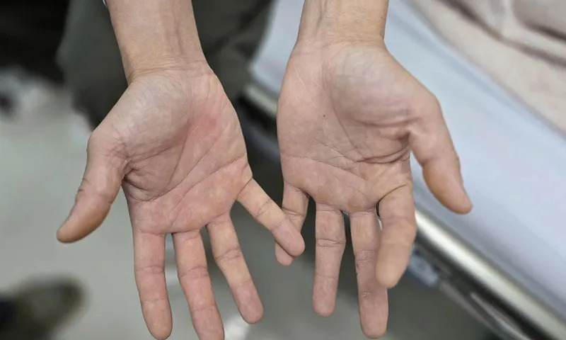 Hai vợ chồng nghiện bóng cười bị tổn thương tủy sống nặng