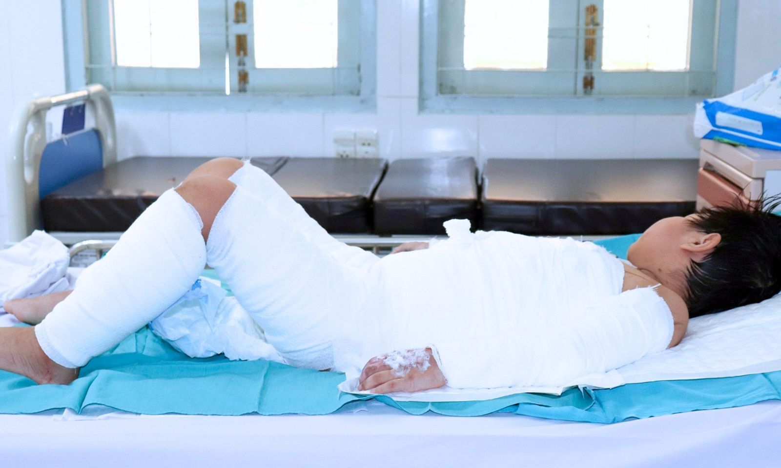 Bé trai bị bỏng nặng do nồi nước sôi hấp bánh bao đổ trúng người