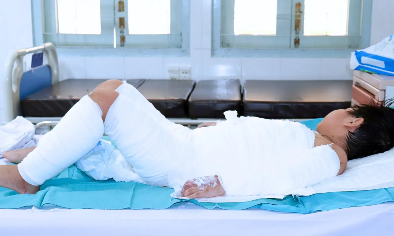 Bé trai bị bỏng nặng do nồi nước sôi hấp bánh bao đổ trúng người