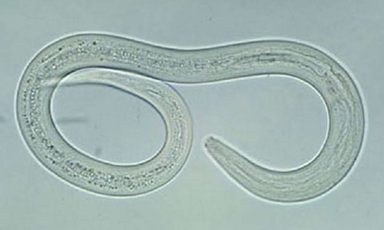 Cụ ông phù chân tay, sụt 11 kg vì nhiễm giun lươn