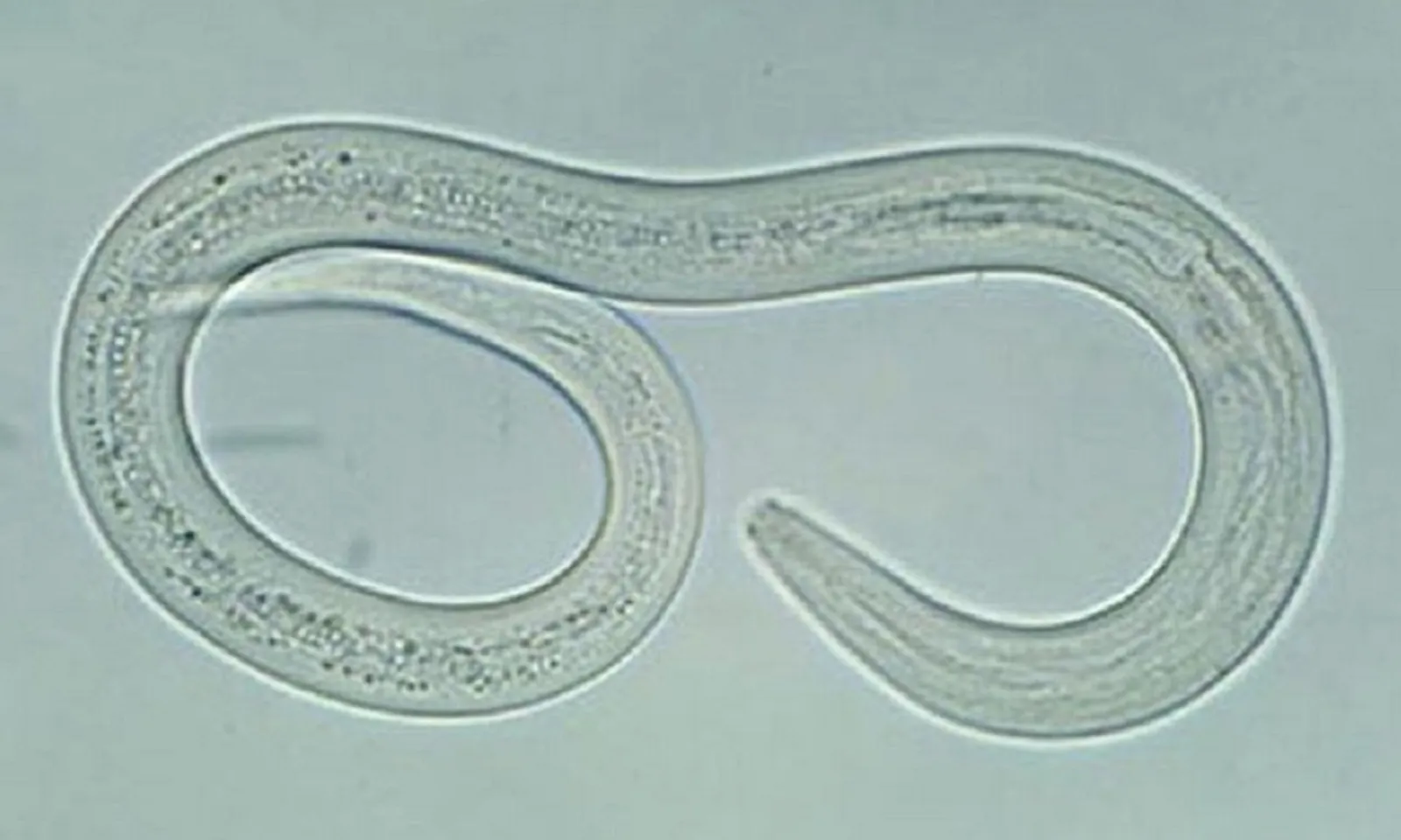 Cụ ông phù chân tay, sụt 11 kg vì nhiễm giun lươn